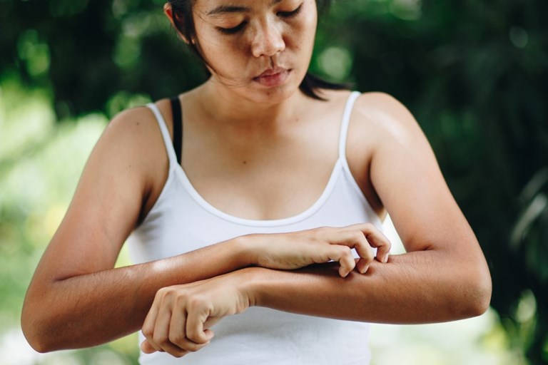 got-hives-hold-the-steroids